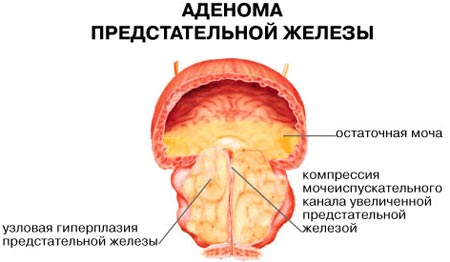 adenoma-predstatelnoy-zhelezyi