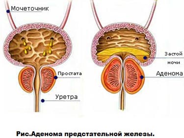 adenoma-prostaty-2