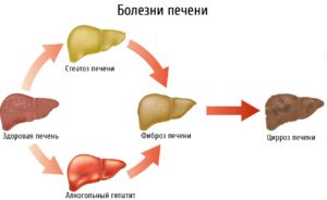 Kakie-simptomy-i-lechenie-steatoza-pecheni-v-domashnih-usloviyah-3