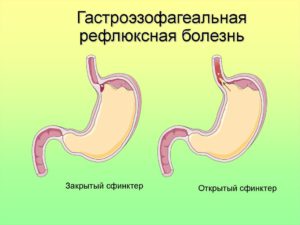 upotreblenie-bananov-pri-raznyh-tipah-gastrita-sovety-po-upotrebleniyu-i-vozmozhnye-ogranicheniya-21