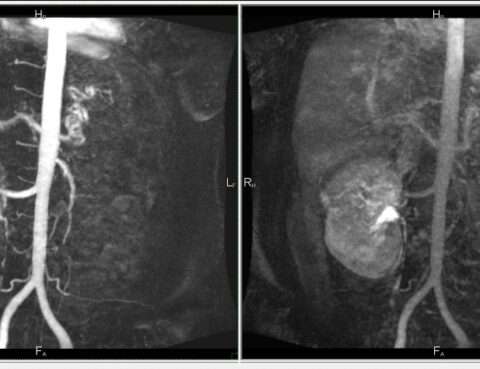 МРТ кровотока в почечных артериях